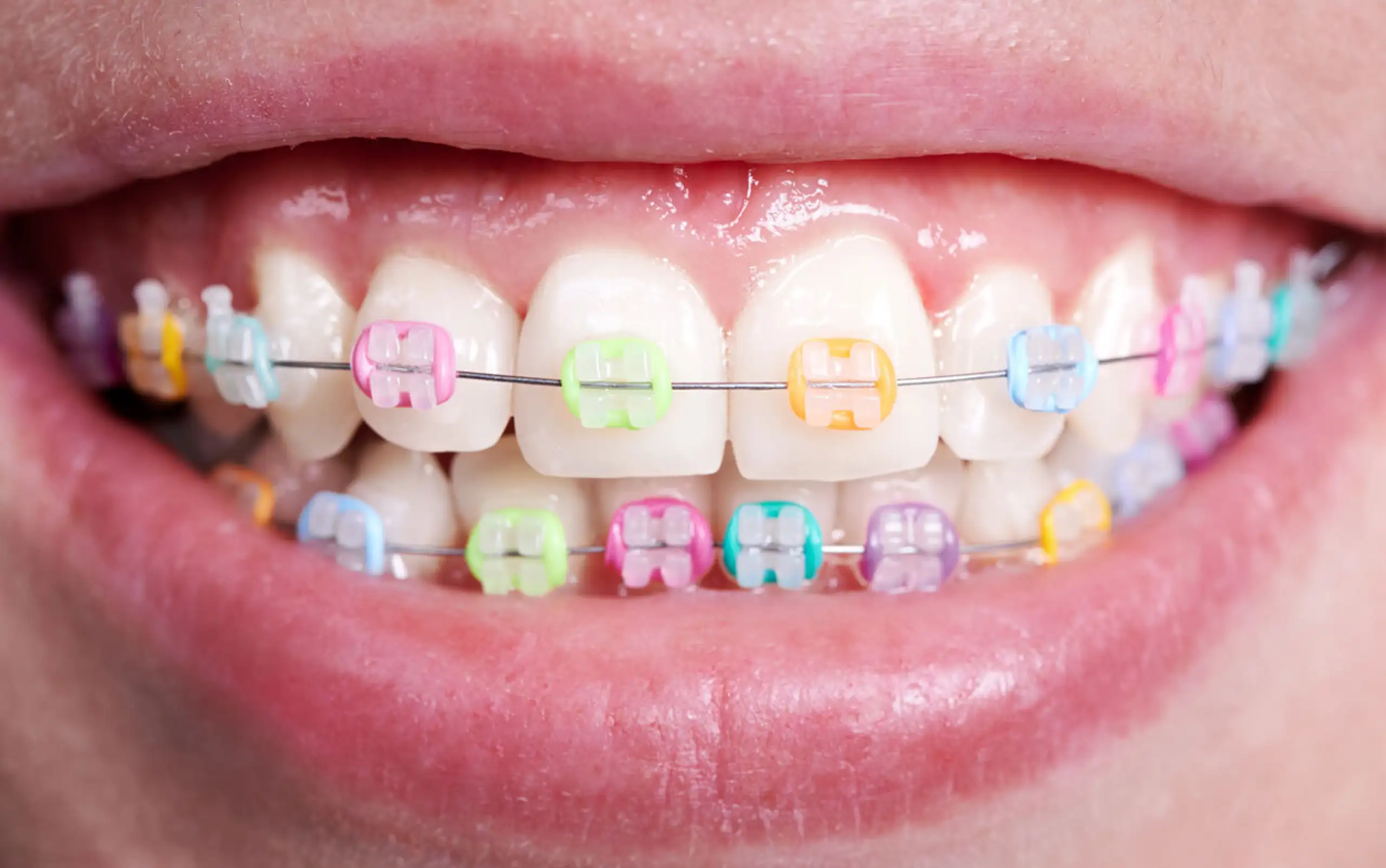 Do You Have Colors for Braces Brackets?