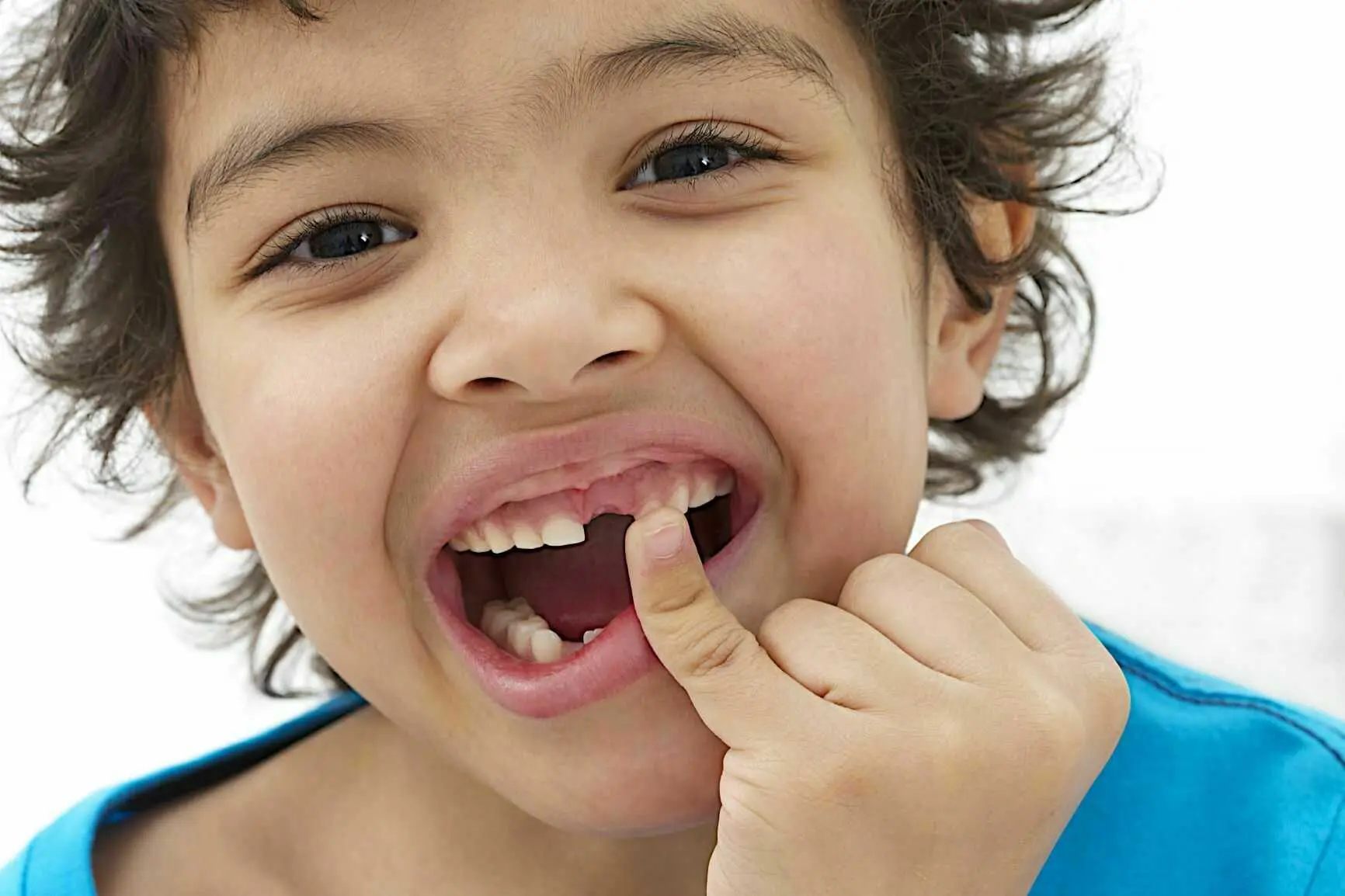 Chipped Tooth Repair