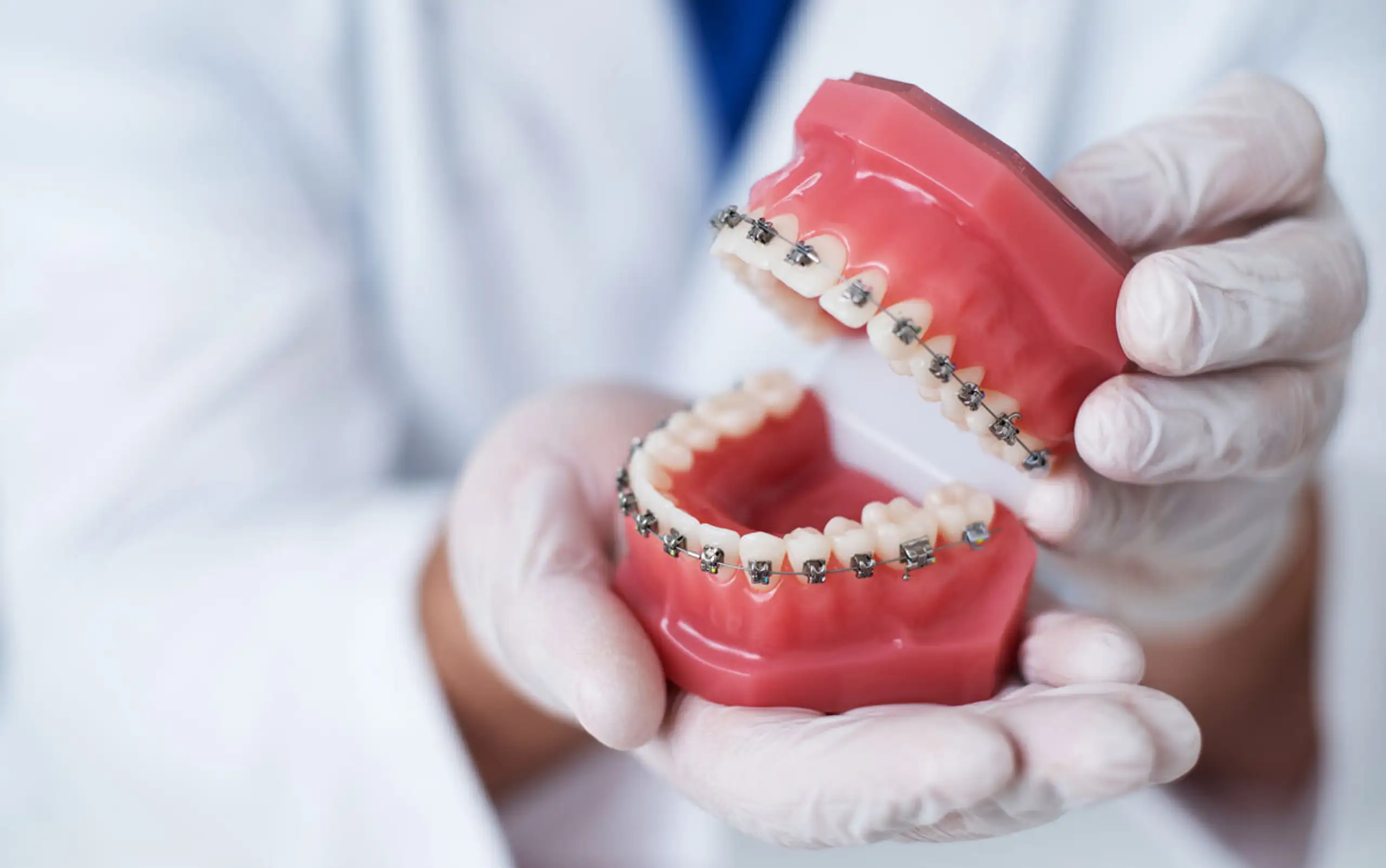 Types of Orthodontic Braces